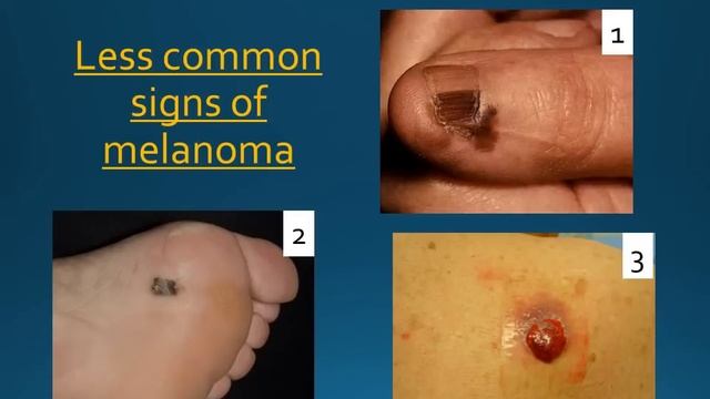 Skin cancer education смотреть онлайн