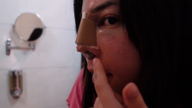 I GOT A NOSE JOB IN TURKEY // Asian Ethnic Rhinoplasty With Dr. Alpaslan Yildirim (@estetik_burun)