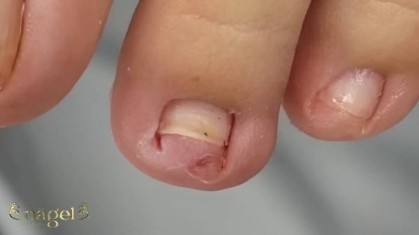 ?TRANSFORMAÇÃO DA UNHA DO SEGUNDO DEDO DO PÉ #nails #ingrowntoenail