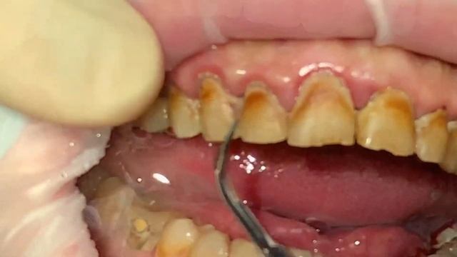 Удаление зубного камня, ультразвуковая чистка зубов / Dental plaque смотреть онлайн