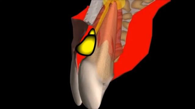Как лечат свищ над зубом  Периодонтит  Стоматология