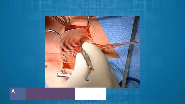 Паховое грыжесечение способом Лихтенштейна с использованием самофиксирующего имплантата смотреть онлайн