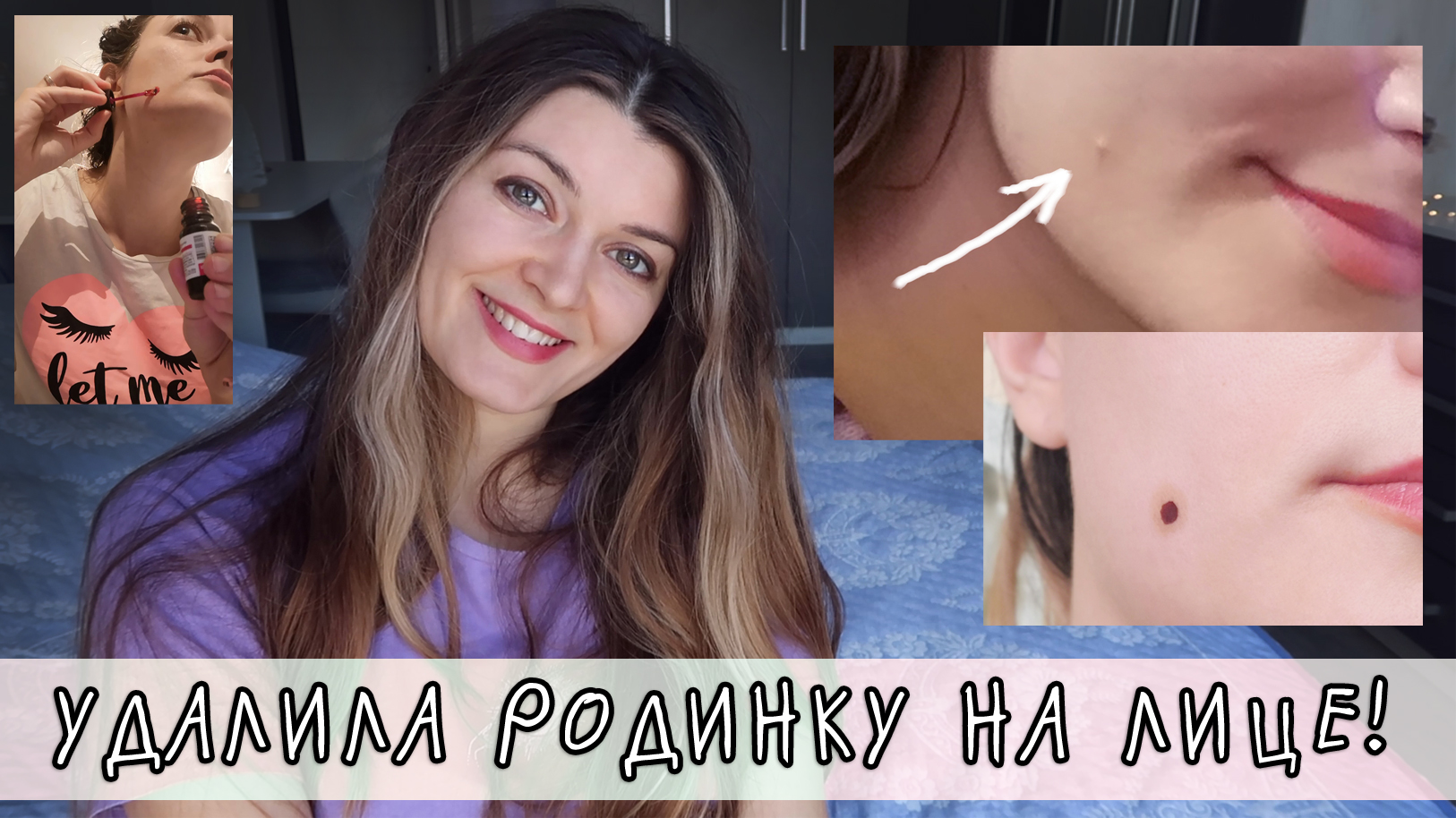 УДАЛИЛА РОДИНКУ лазером на лице - как заживает удаленная родинка, отзыв после удаления родинки смотреть онлайн