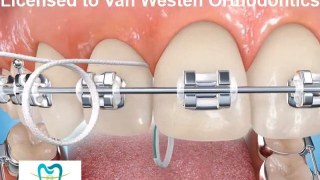 Flossing with superfloss смотреть онлайн