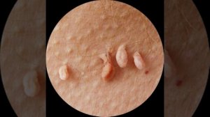 Папиллома. Ацикловир.