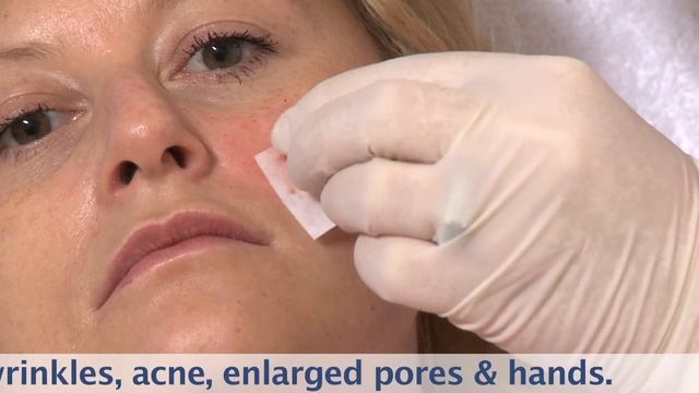 Dermaheal HSR For Skin Rejuvenation