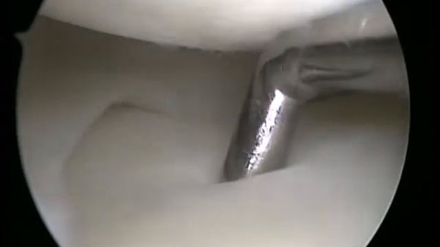 Размягчение поверхностного слоя хряща латерального мыщелка большеберцовой кости смотреть онлайн