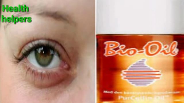 Bio oil honest review । Bio oil ke fayde । Bio oil for acne scars । Bio oil kaise use kare смотреть онлайн
