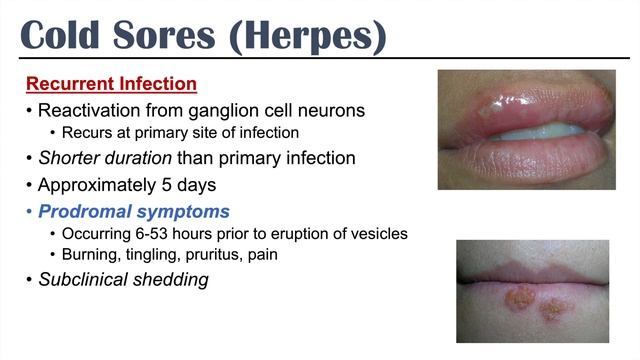 Cold Sores | Oral Herpes | Causes, Signs & Symptoms, Treatment смотреть онлайн