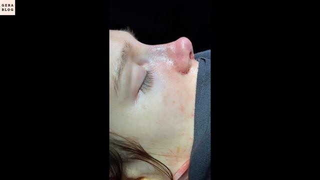 Пол года после ринопластики. Очень натуральный носик. смотреть онлайн