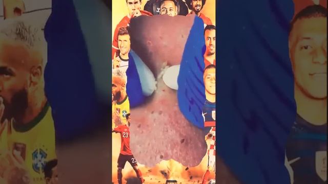 Blackheads Removal | Acne Treatment and Very Satisfying Satisfying Pimple pop #blackheads смотреть онлайн