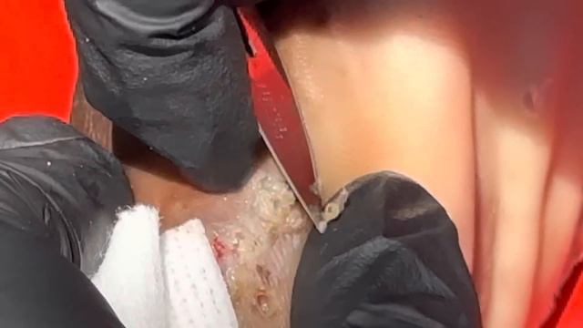 Henry's Jigger Digging - Soft, Lighter Skin Whole Jiggers Pulled Out - Full Video @riseupsociety.ne