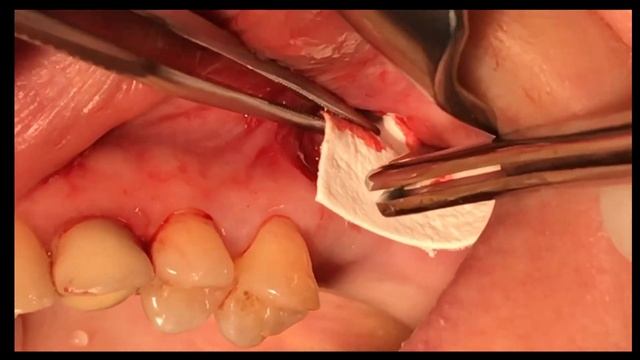Sinus Lift Procedure / 5 steps/ Синусліфтинг смотреть онлайн