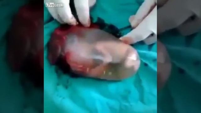 Выкидыш 16 недель. Живой, а помочь невозможно смотреть онлайн