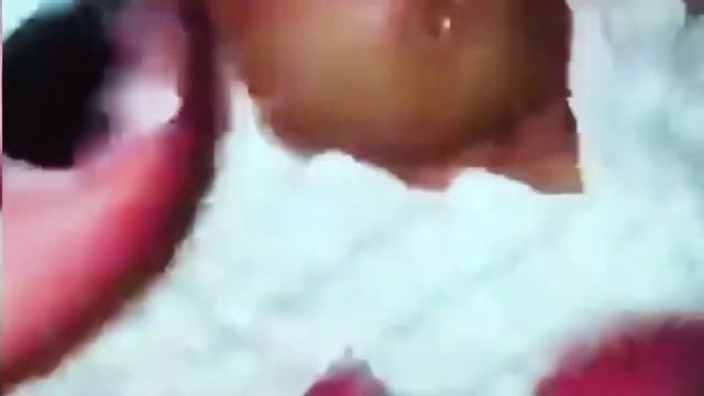 ЖЕСТЬ!СЛАБОНЕРВНЫМ НЕ СМОТРЕТЬ!Выдавливание прыщей,Прыщи, черные точки, гной