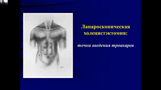 острый холецистит смотреть онлайн