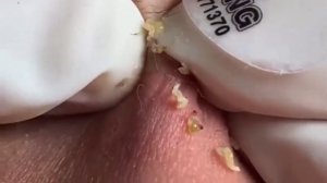 ✅ Выдавливание прыщей #4