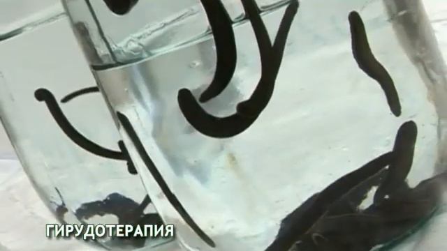 Гирудотерапия смотреть онлайн