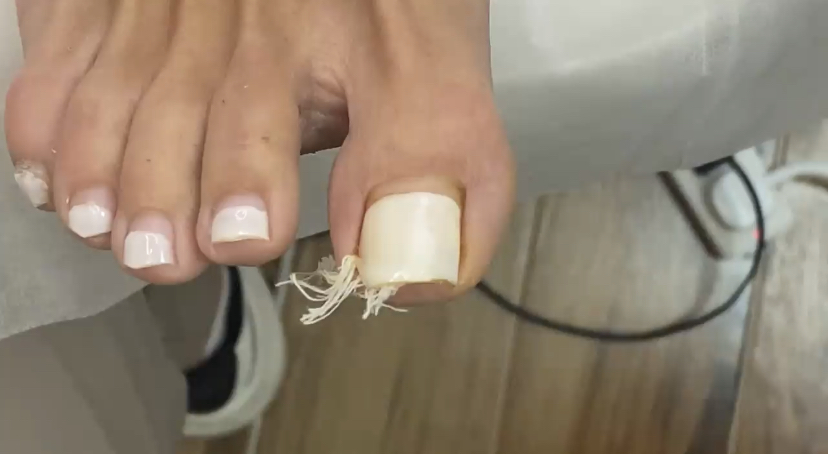 Вросший ноготь смотреть онлайн