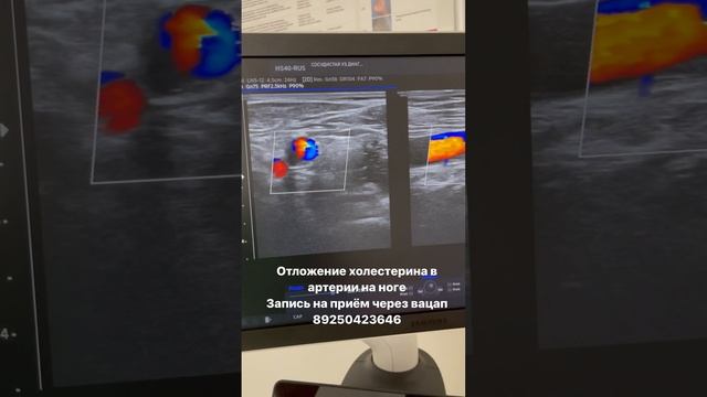Атеросклероз лечение. Как снизить холестерин. Лечение сосудов. Узи сосудов. Сосудистый хирург. Флебо смотреть онлайн