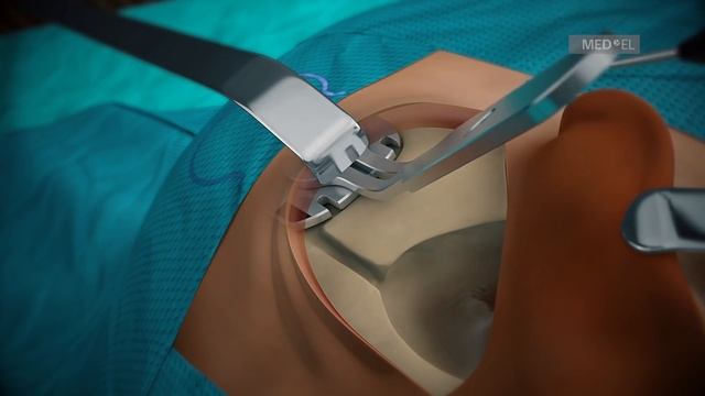 SYNCHRONY PIN Cochlear Implant Surgical Guidelines