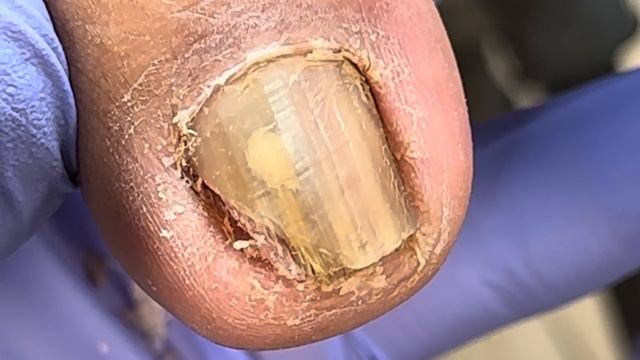 Completely Broken Onychomycosis, Pulling Out Embedded Nails【Doctor Liu Pedicure】