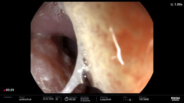 Esophageal cancer/ аденокарцинома пищевода смотреть онлайн