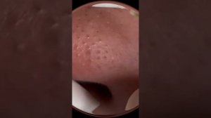 Акне. Черные точки. Вросшие волосы и прыщи. Ушная пробка и сера!