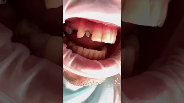 Коронка на зуб смотреть онлайн