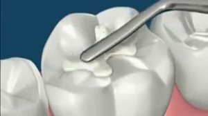 Удаление кариеса на зубе