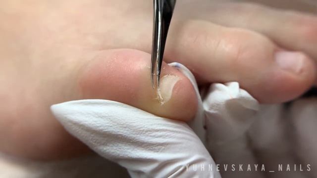 Педикюр мизинчика #педикюр #педикюрмосква #подолог #подология #мозоль #аппаратныйпедикюр смотреть онлайн