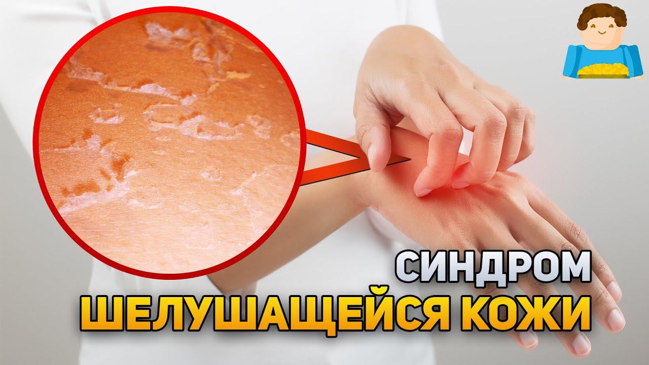 Из-за этого редкого синдрома кожа постоянно шелушится | Plushkin смотреть онлайн