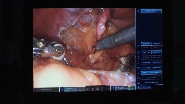 Clinical Trials vital for GYN Cancers: Sentinel Lymph Node Mapping смотреть онлайн