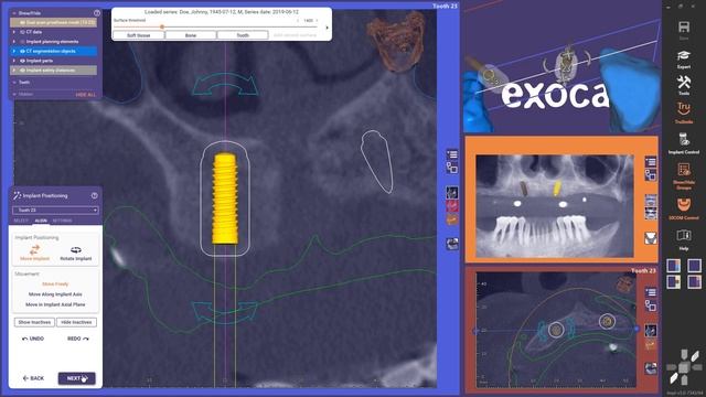 Patient Case Demonstration (1/6): exoplan & Guide Creator Module смотреть онлайн