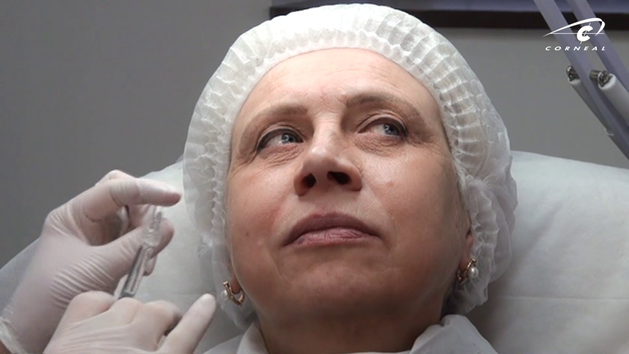 Контурная пластика обучение. Выбор техники коррекции носогубной складки. смотреть онлайн