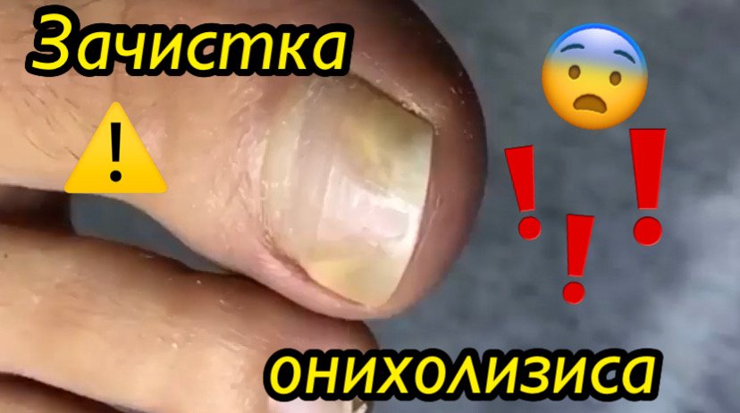 Зачистка онихолизиса?⚠️? смотреть онлайн
