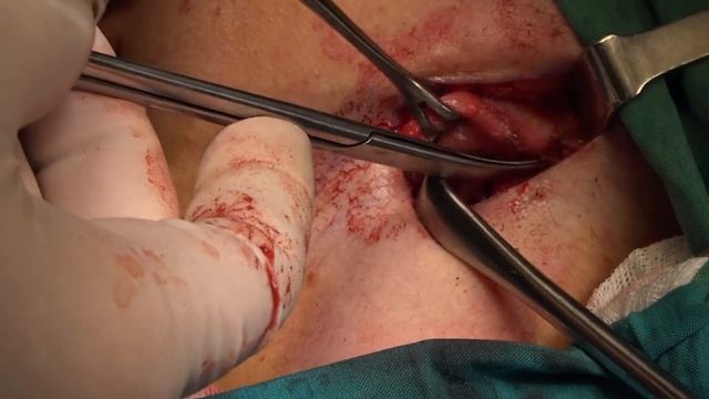 Submandibular Gland Tumor смотреть онлайн