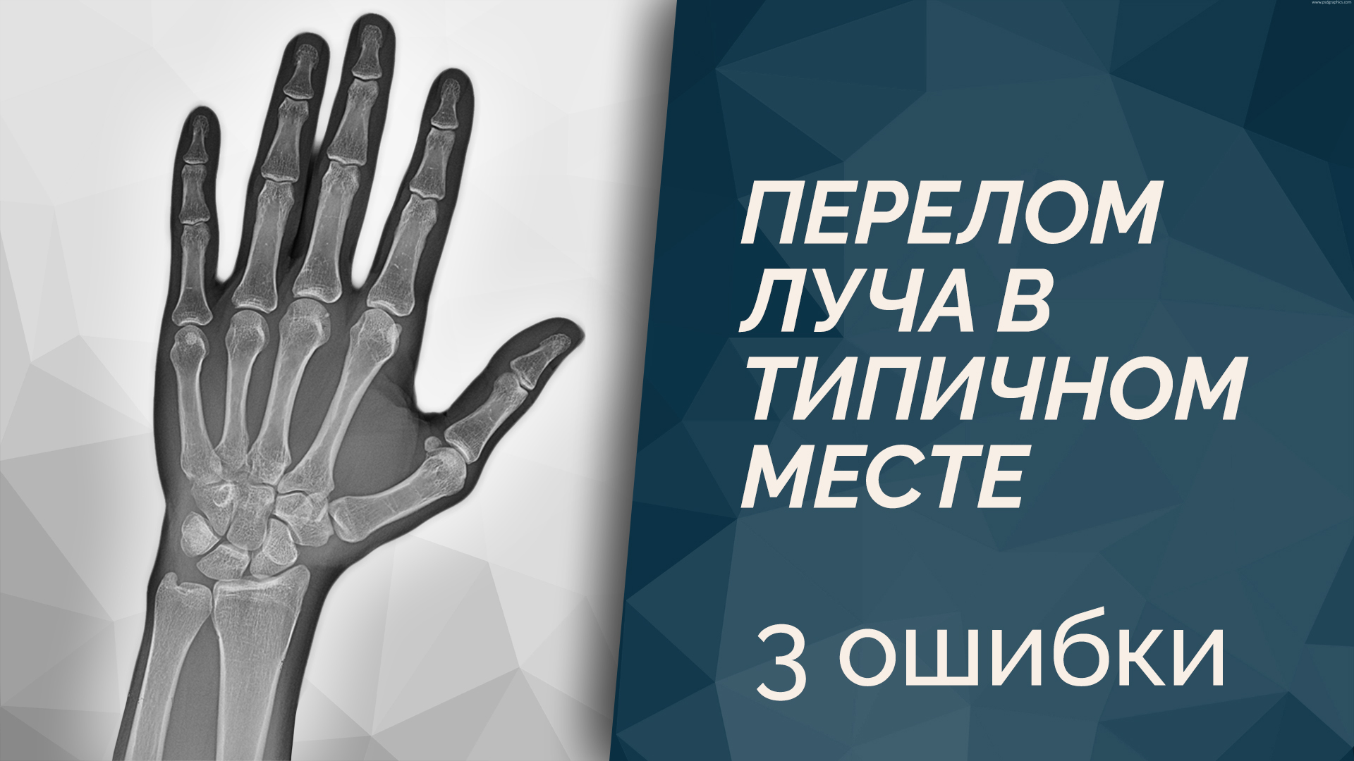 3 ошибки врача и пациента - Реабилитация луча в типичном месте смотреть онлайн