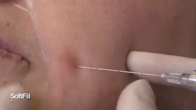 Применение техники Soft Filling Technique (носогубные морщинки) МедТехУрал смотреть онлайн