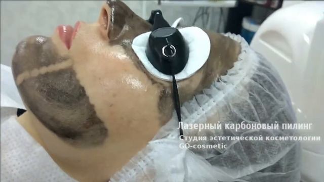 Лазерный карбоновый пилинг - эффективно, запускает процесс омоложения смотреть онлайн