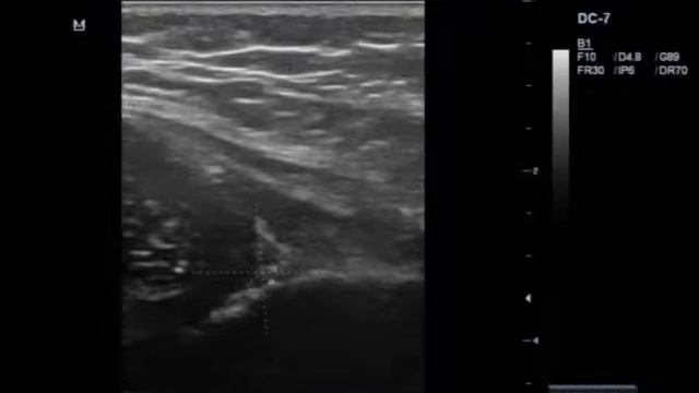 Патология тазобедренного сустава 2 смотреть онлайн