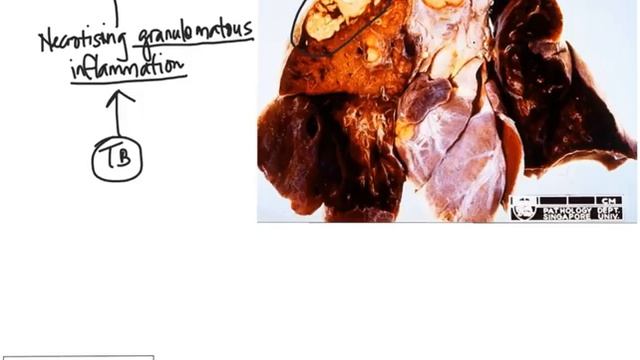 Lung with Lymph nodes: TB Gross and Micro correlates смотреть онлайн