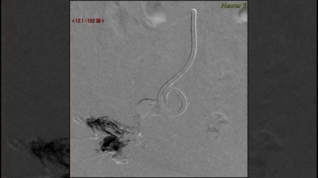 glue injection into the lymphatics via the inguinal lymph node смотреть онлайн