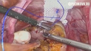 Лапароскопическая коррекция генитального пролапса сетчатым имплантом по авторской методике