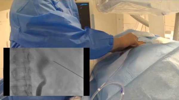 Percutaneous Nephrostomy procedure and technique: starter pack