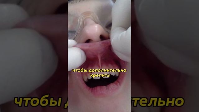 Пирсинг на уздечке. Последствия