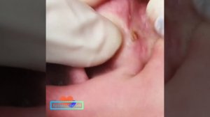 Acne in the ear - прыщи в ухе