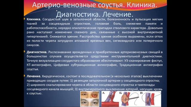 Аневризмы головного мозга смотреть онлайн