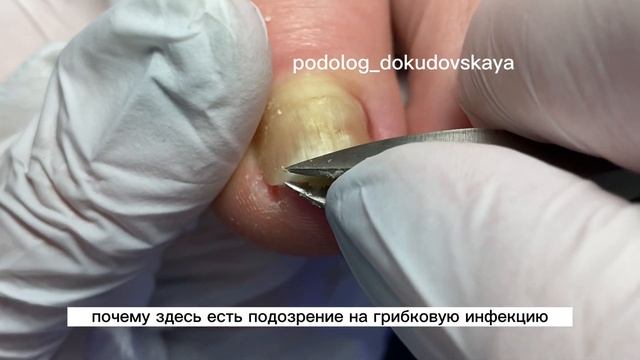 Деформированный ноготь после другого подолога #подология #курсыпедикюра #подологмосква #вросшие