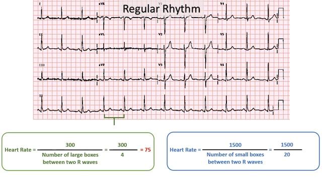 ECG: Heart Rate Calculation | In 2 minutes | ECG Interpretation смотреть онлайн
